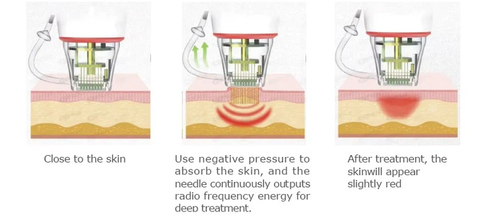 RF Microneedling machine RF Microneedling machine
